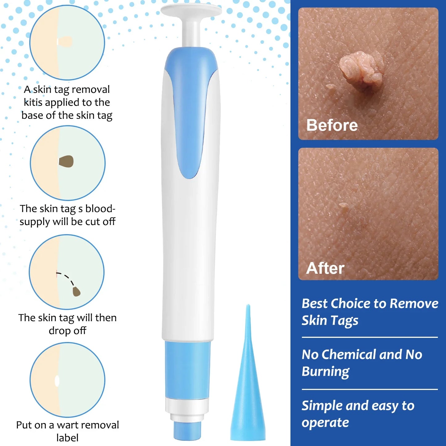 2 In1 Painless Auto Skin Tag Mole Wart Removal Kit